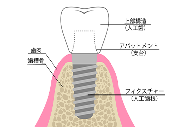 インプラントの構造