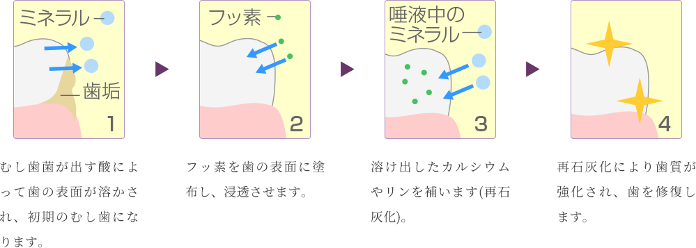 フッ素のむし歯抑制効果