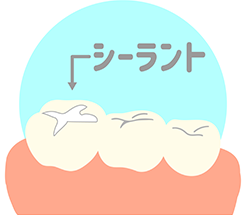 シーラント